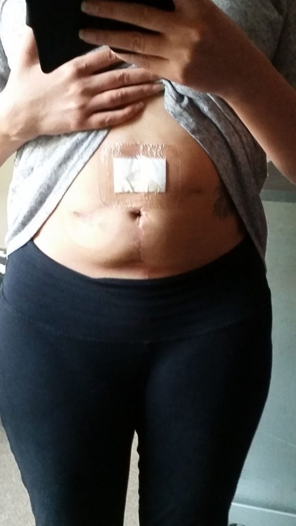 6 Weeks Post Colostomy Reversal Op! I survived! Tyranny of Pink